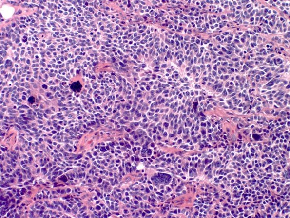 9B2 Medulloblastoma, LCA (Case 9) H&E 4