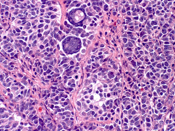 9B3 Medulloblastoma, LCA (Case 9) H&E 2