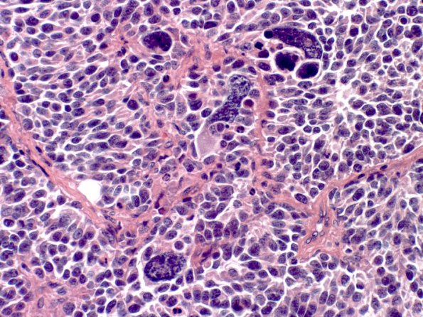 9B4 Medulloblastoma, LCA (Case 9) H&E 5