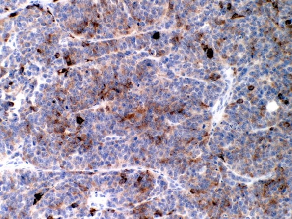 9C Medulloblastoma, LCA (Case 9) H&E SYN 1