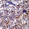 9D Medulloblastoma, LCA (Case 9) H&E NeuN 1