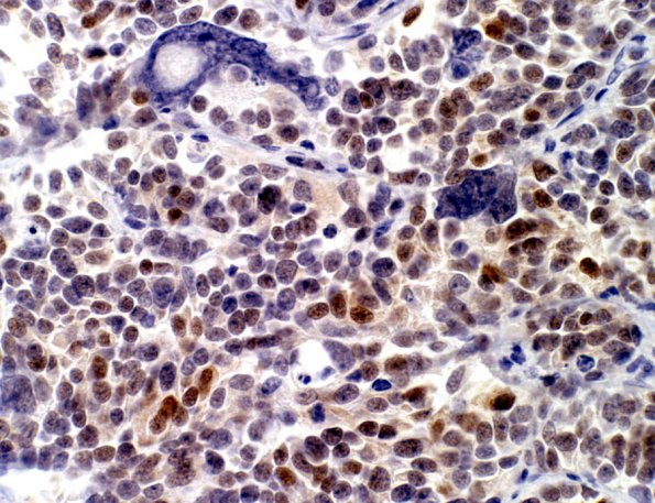 9D Medulloblastoma, LCA (Case 9) H&E NeuN 1