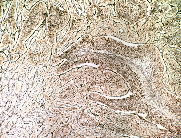 9E1 Medulloblastoma, LCA (Case 9) H&E Retic 1