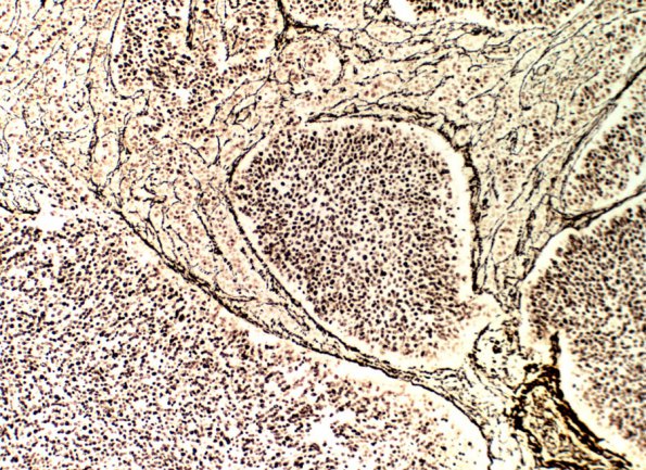 9E2 Medulloblastoma, LCA (Case 9) H&E Retic 2