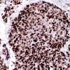 9F Medulloblastoma, LCA (Case 9) H&E MIB 2