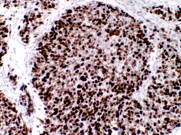 9F Medulloblastoma, LCA (Case 9) H&E MIB 2