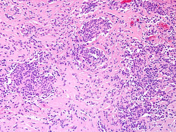 1A3 MedMyoB Glial (Case 1) Area 1 H&E.jpg