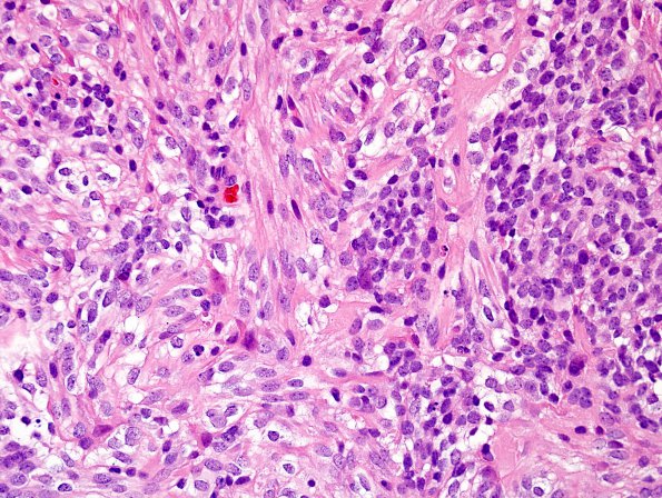 1A4 MedMyoB Glial (Case 1) Area 2 H&E 1.jpg