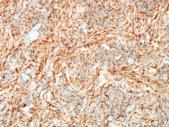 1B2 MedMyoB Glial (Case 1) Area 2 SYN.jpg