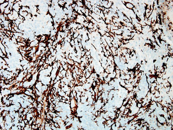 1C3 MedMyoB Glial (Case 1) Area 2 GFAP.jpg