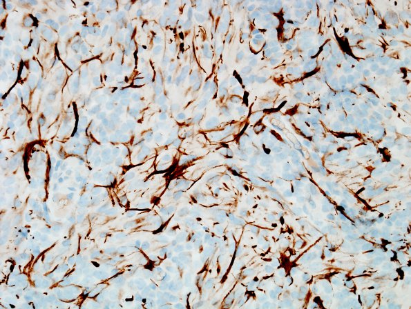 1D3 MedMyoB Glial (Case 1) Area 2 desmin 2.jpg