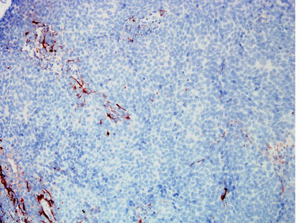 1D4 MedMyoB Glial (Case 1) Area 3 desmin 2.jpg