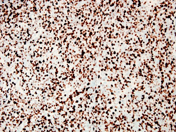 1E1 MedMyoB Glial (Case 1) Area 3 Ki67.jpg