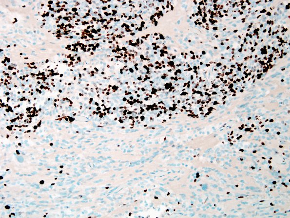 1E3 MedMyoB Glial (Case 1) Area 1 Ki67 1.jpg