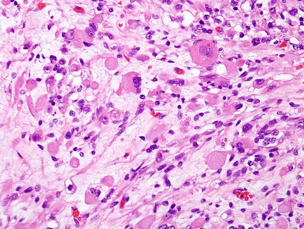 2B10 MedMyoBl LC-A (Case 2) H&E 12