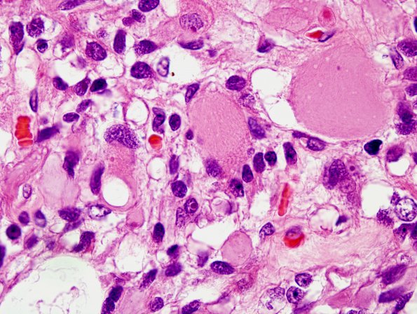 2B12 MedMyoBl LC-A (Case 2) H&E 100X 2