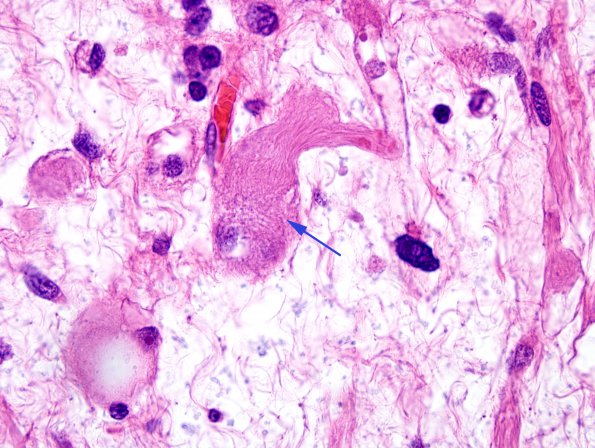 2B13 MedMyoBl LC-A (Case 2) H&E 100X 12