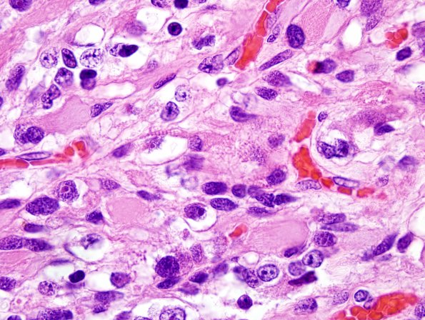 2B14 MedMyoBl LC-A (Case 2) H&E 100X 3