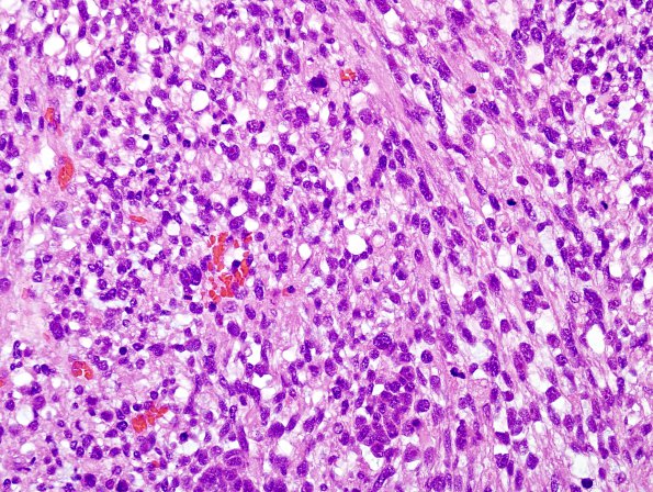 2B8 MedMyoBl LC-A (Case 2) H&E 2