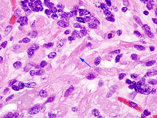 2B9 MedMyoBl LC-A (Case 2) H&E 100X 21 copy