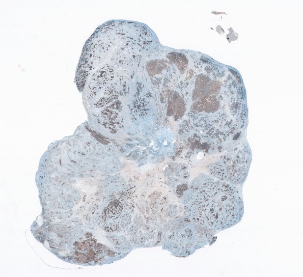 2C1 MedMyoBl LC-A (Case 2) SYN WM