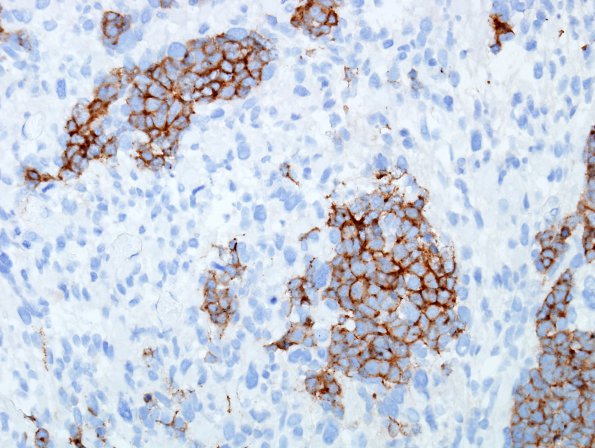 2C3 MedMyoBl LC-A (Case 2) SYN 1