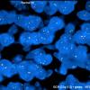 2F1 MedMyoBl LC-A (Case 2) bcr-nf2 dense