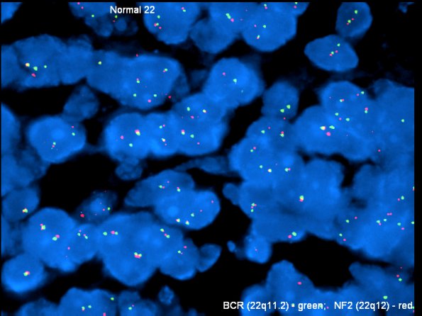 2F1 MedMyoBl LC-A (Case 2) bcr-nf2 dense