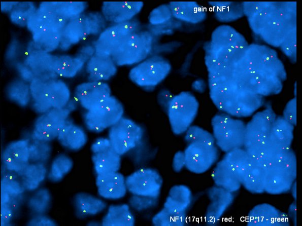 2F3 MedMyoBl LC-A (Case 2) c17-nf1 dense