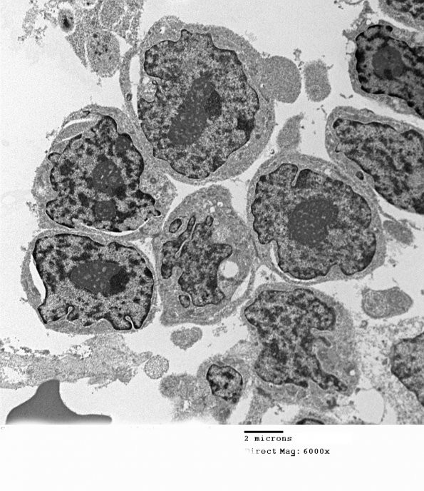 2H1 MedMyoBl LC-A (Case 2 EM 012 - Copy