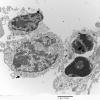 2H2 MedMyoBl LC-A (Case 2) EM 011 - Copy