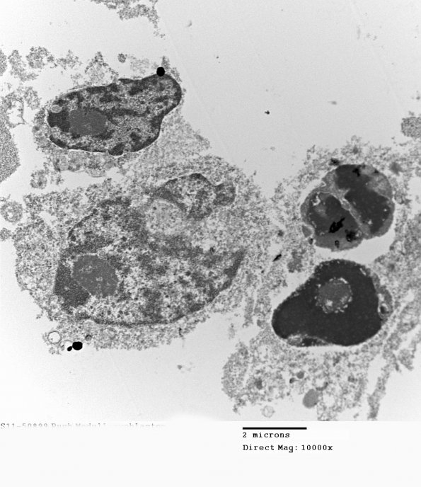 2H2 MedMyoBl LC-A (Case 2) EM 011 - Copy