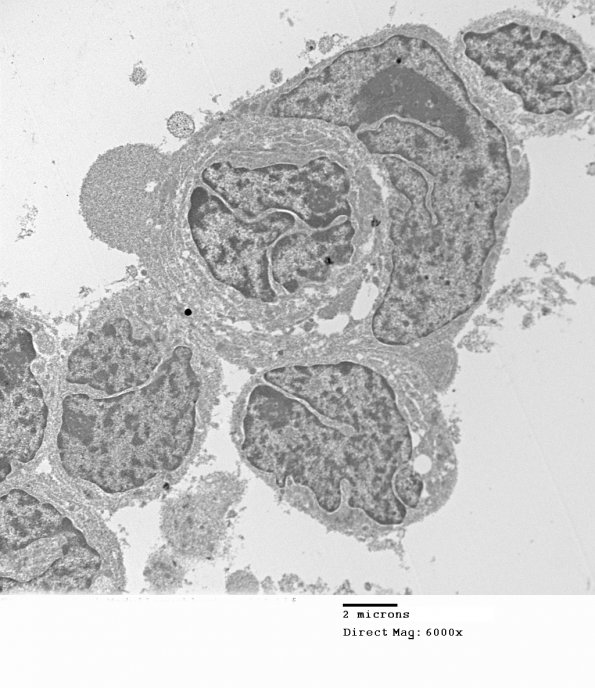 2H3A MedMyoBl LC-A (Case 2) EM 008 - Copy