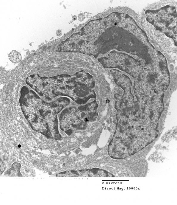 2H3B MedMyoBl LC-A (Case 2) EM 010 - Copy