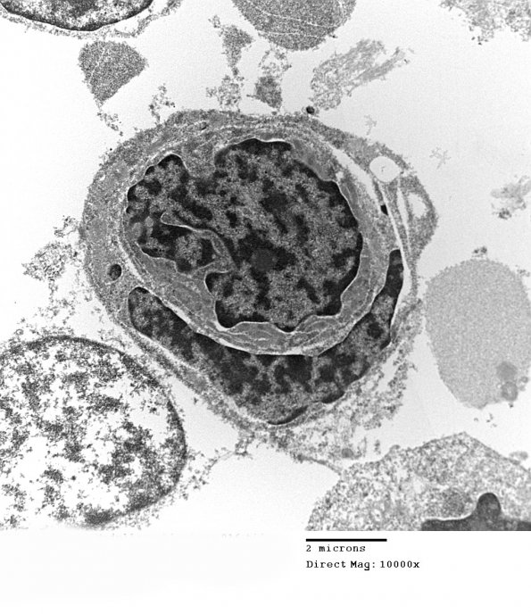 2H5 MedMyoBl LC-A (Case 2) EM 016 - Copy