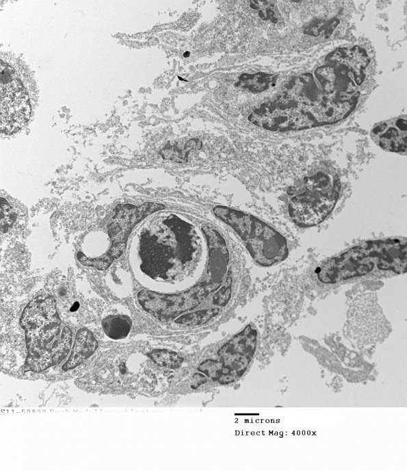 2H7 MedMyoBl LC-A (Case 2) 021 - Copy