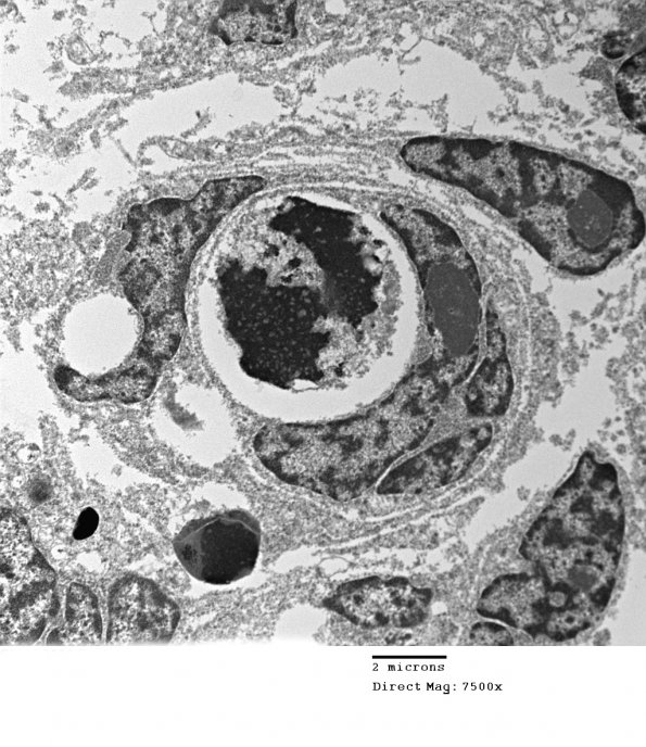 2H8 MedMyoBl LC-A (Case 2) 022 - Copy