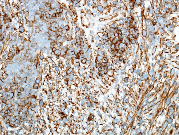 2J MedMyoBl LC-A (Case 2) b-catenin 9