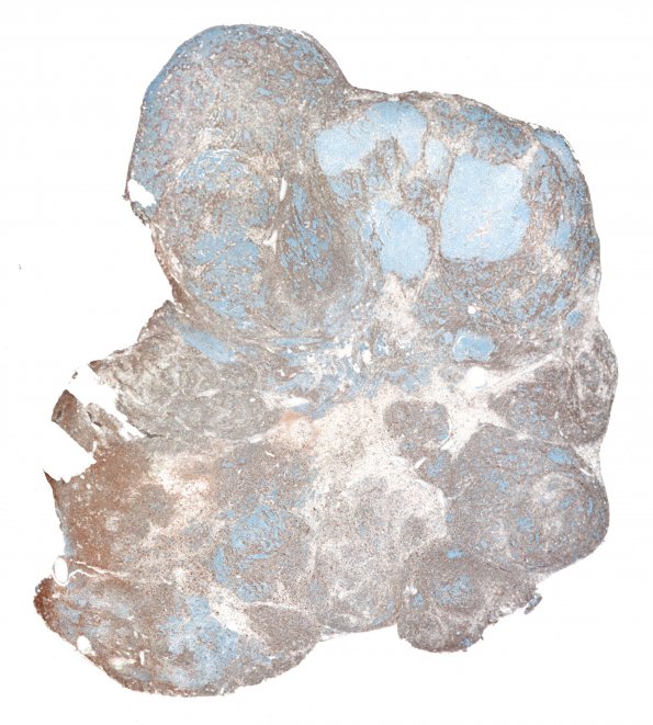 2K1 MedMyoBl LC-A (Case 2) Desmin WM