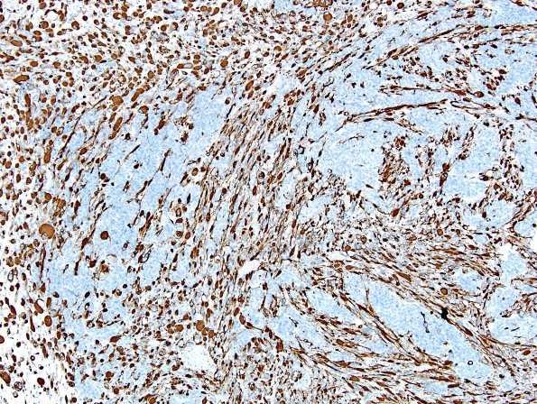 2K3 MedMyoBl LC-A (Case 2) desmin 5