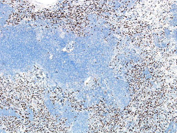 2L2 MedMyoBl LC-A (Case 2) Myogenin 2