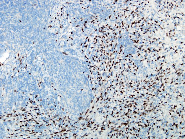 2L3 MedMyoBl LC-A (Case 2) Myogenin 5