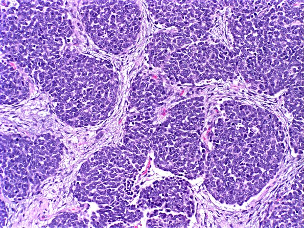 3A1 Medullomyoblastoma (Case 3) H&E 1