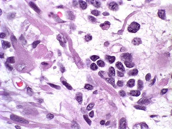 3A4 Medullomyoblastoma (Case 3) H&E 4