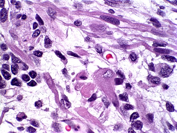 3A5 Medullomyoblastoma (Case 3) H&E 5