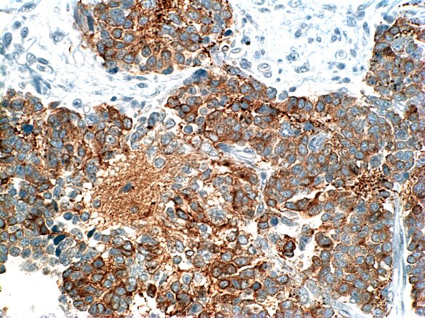 3B1 Medullomyoblastoma (Case 3) SYN 1