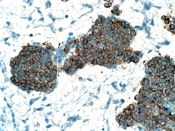 3B2 Medullomyoblastoma (Case 3) SYN 2