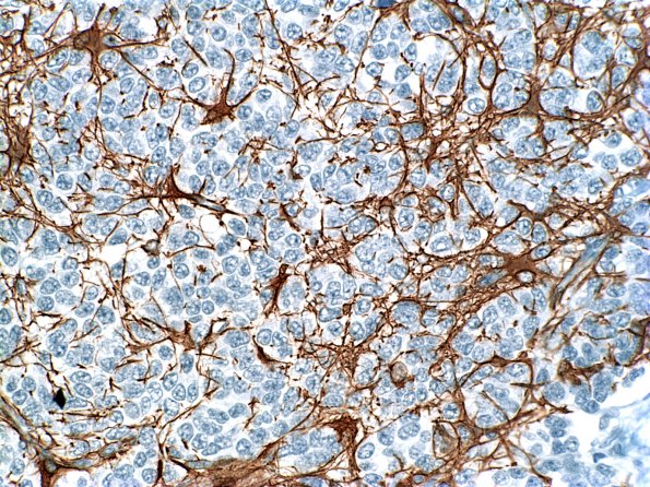 3C Medullomyoblastoma (Case 3) GFAP