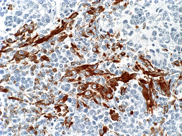 3E Medullomyoblastoma (Case 3) desmin