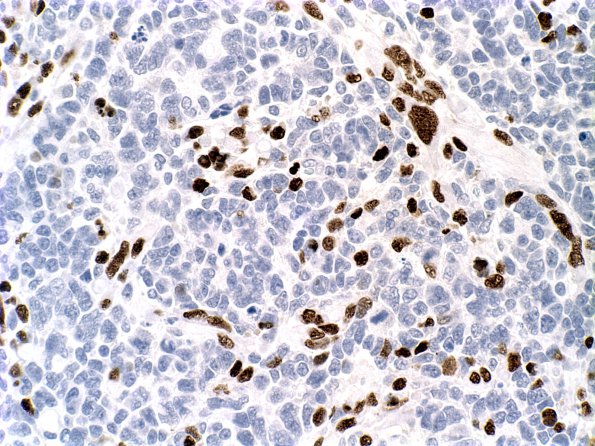 3F Medullomyoblastoma (Case 3) Myogenin 2